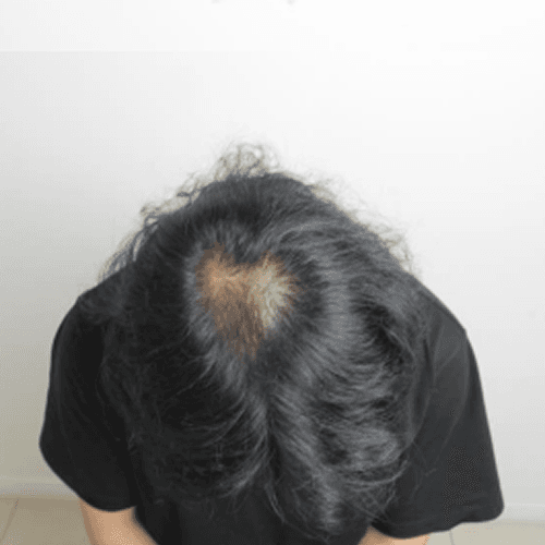 500모 이식 + 줄기세포 주사 10회차 중 3회 BEFORE