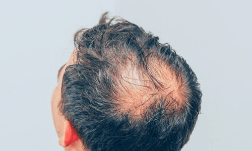 탈모 부위 예시 2