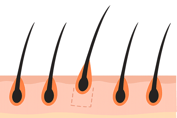 여성 모발이식 과정 이미지